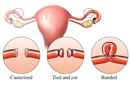 tubal ligation surgery, procedure