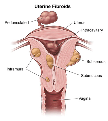 Fibroid Removal, Myomectomy surgery, procedure
